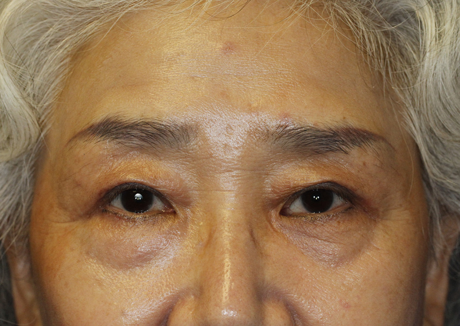 Asian Blepharoplasty After Frontal