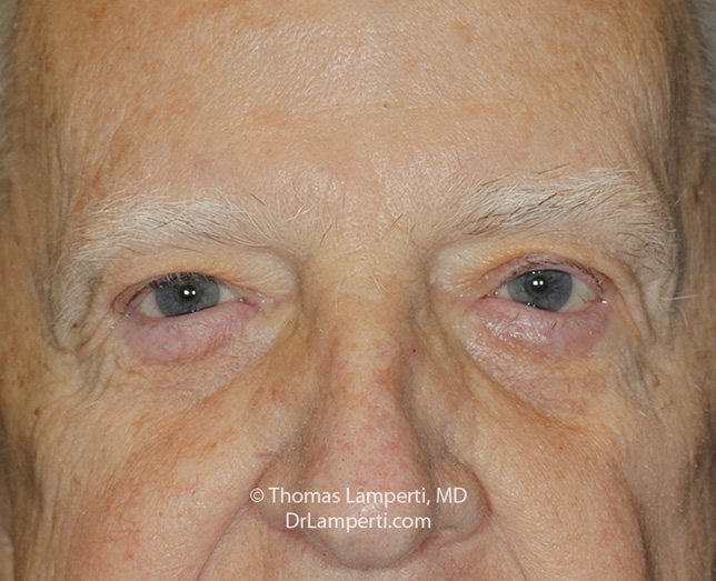 Blepharoplasty and Ptosis Repair After