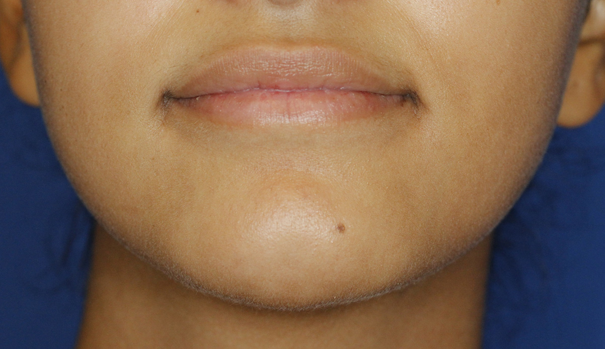 Cleft Chin After Frontal