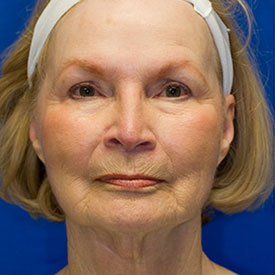Revision Facelift Before Photo