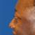 Before Fat Grafting Profile