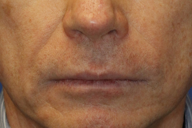 Before Lip Lift Frontal