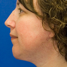 After neck liposuction photo