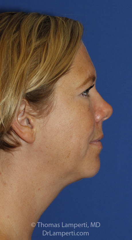 Neck Liposuction R Profile After