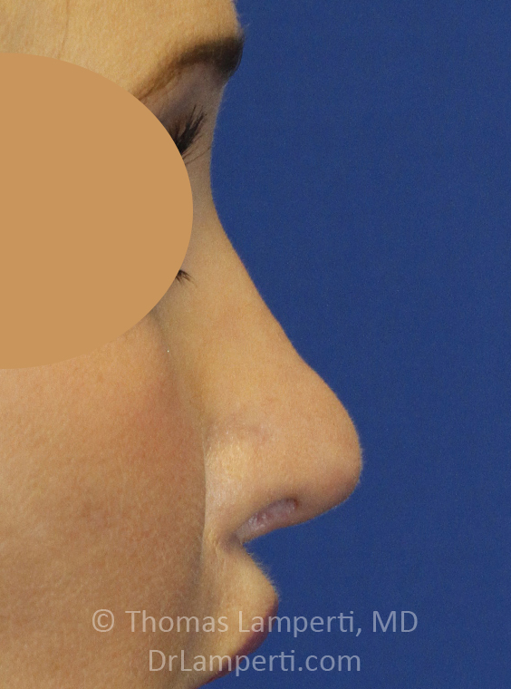 After Revision Rhionoplasty Right Profile