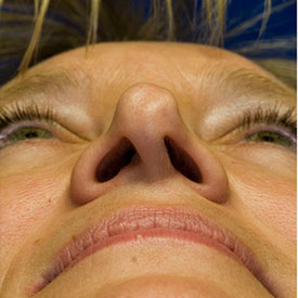 Before asymmetric nostril repair