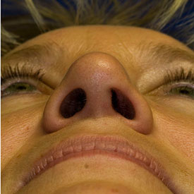 After asymmetric nostril repair