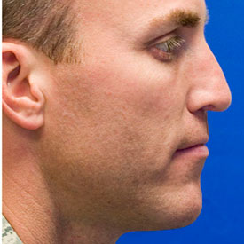 After droopy tip rhinoplasty