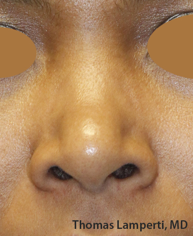 Before Dominican Rhinoplasty Frontal