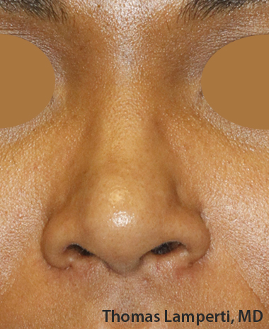 After Dominican Rhinoplasty Frontal