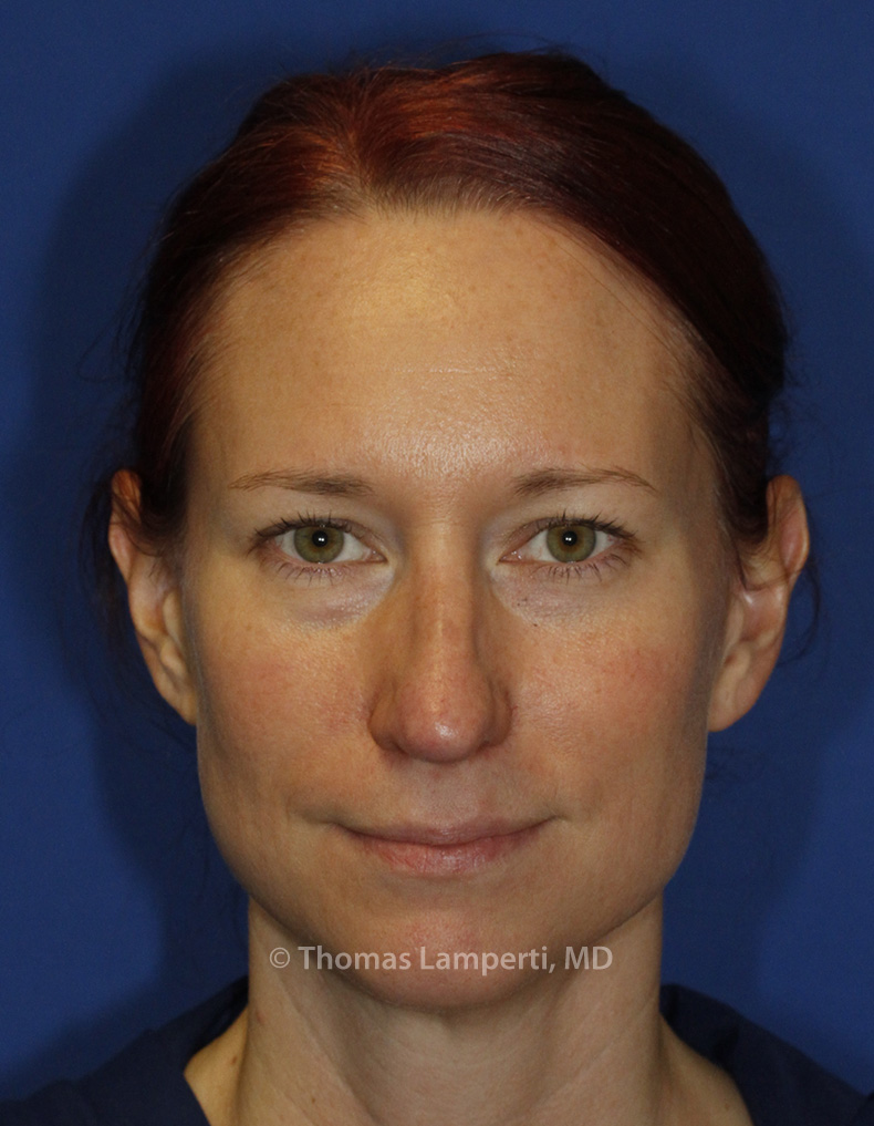 After Rhinoplasty Frontal