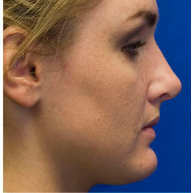 After Rhinoplasty Profile Photo