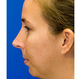 Before profile rhinoplasty photo