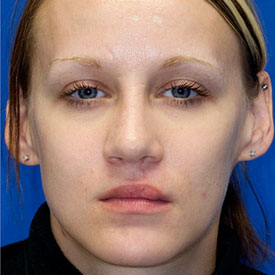 After Cleft Nose Rhinoplasty