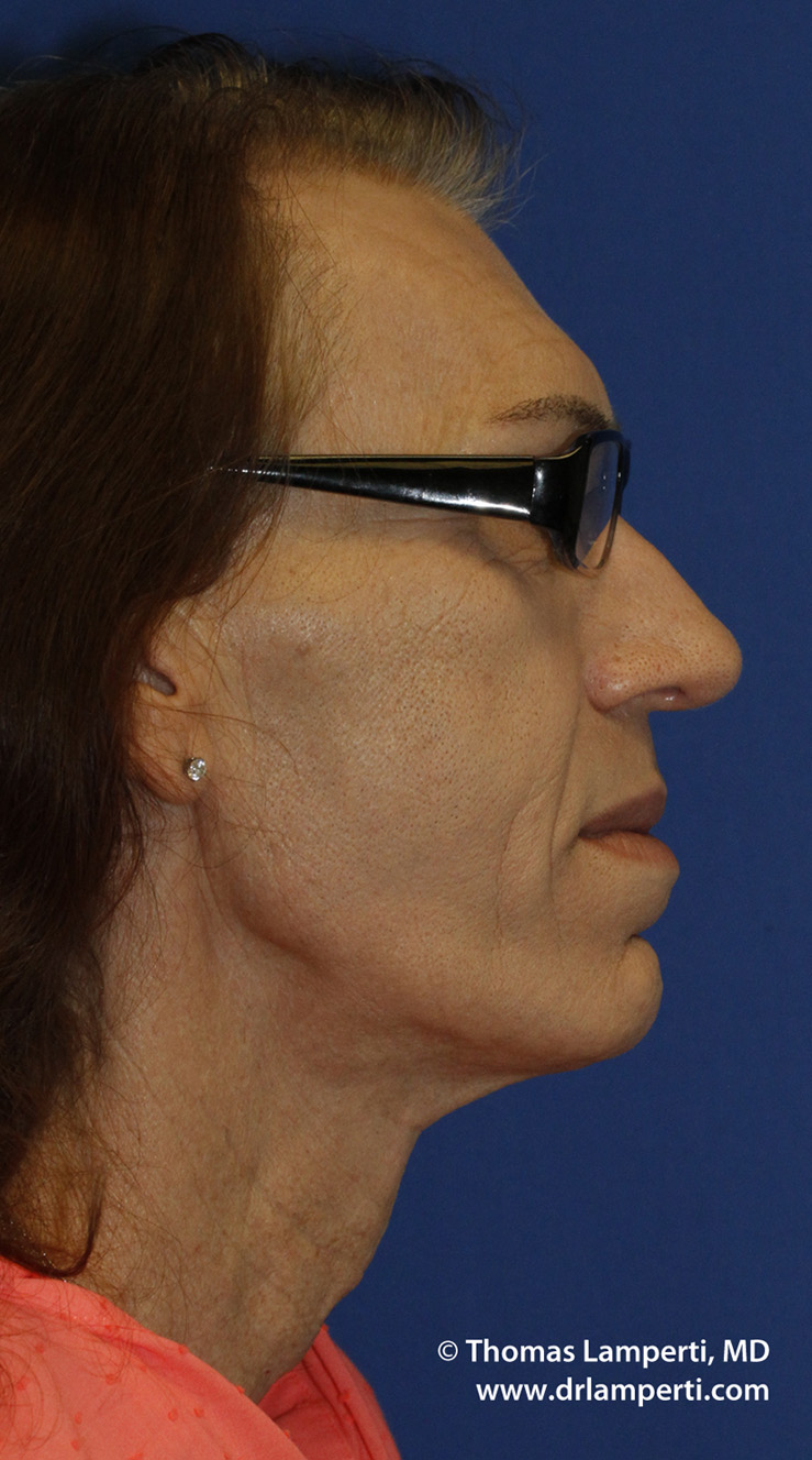 After Tracheal Shave R Profile