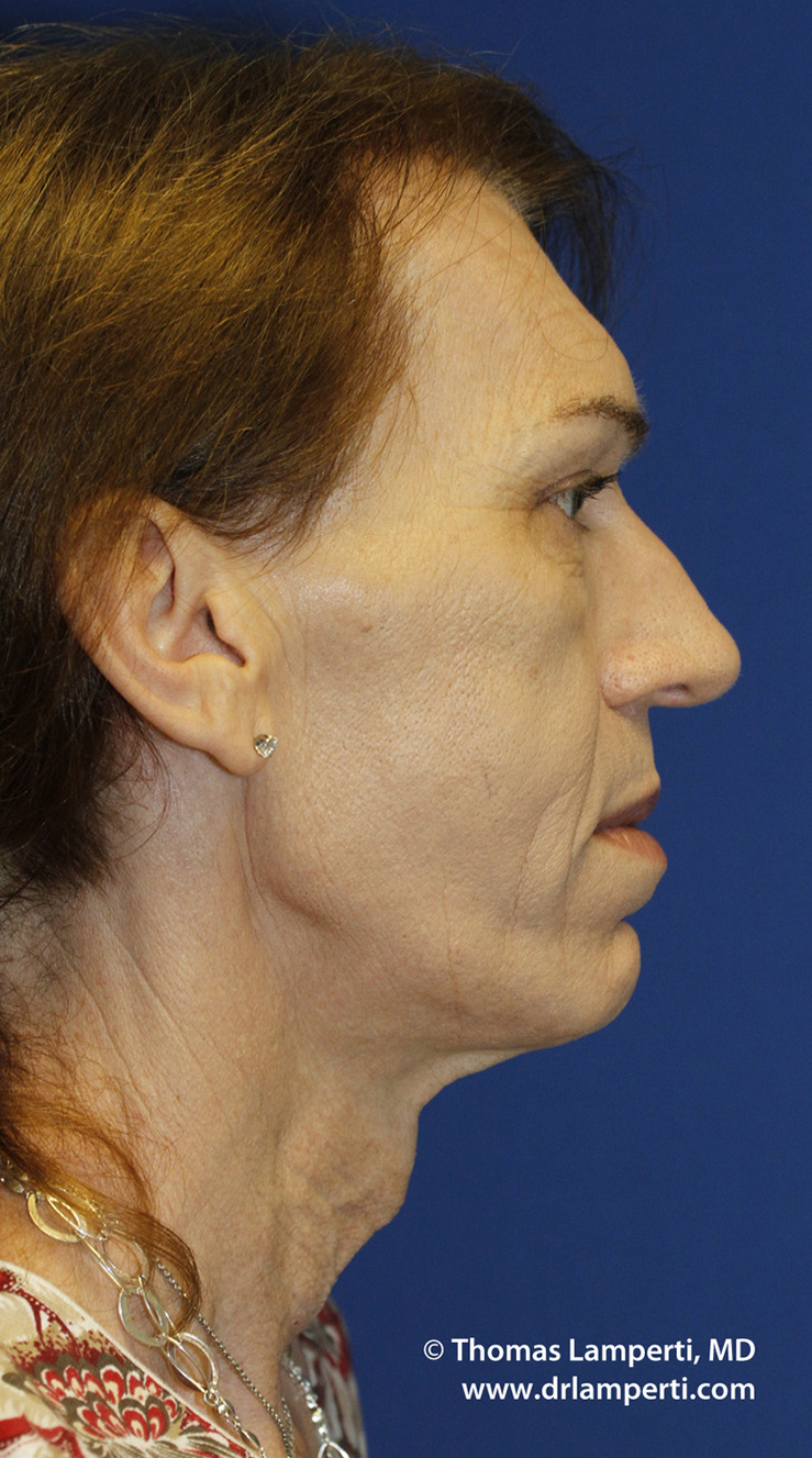 Before Tracheal Shave R Profile