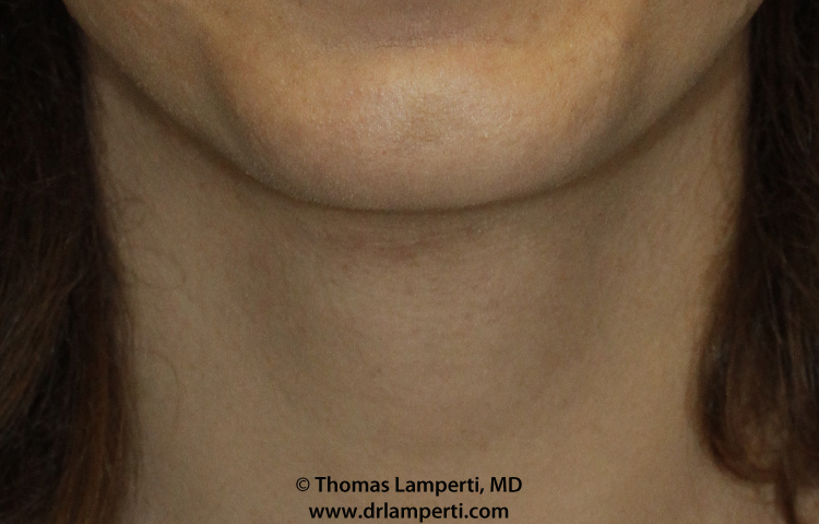Tracheal Shave Frontal After