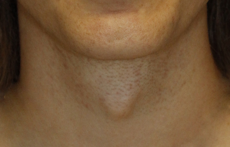 Tracheal Shave Frontal Before