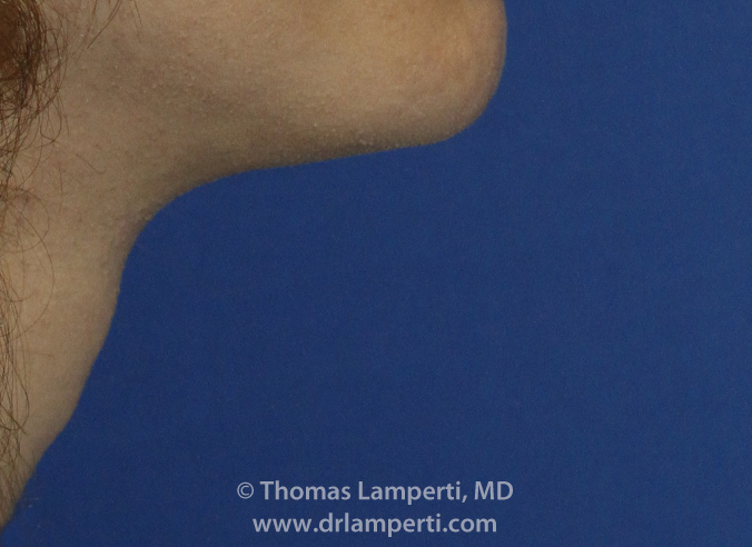 Tracheal Shave R Profile After