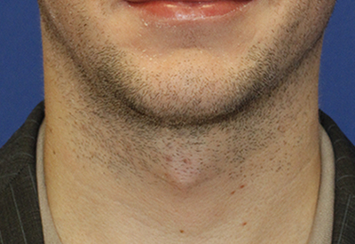 Tracheal Shave Before Frontal