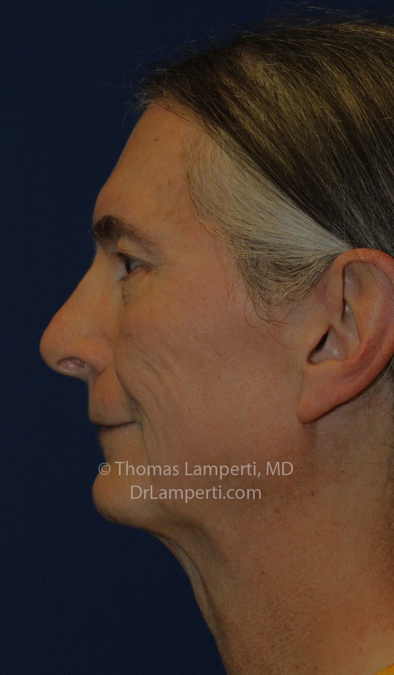 Tracheal Shave L Profile After