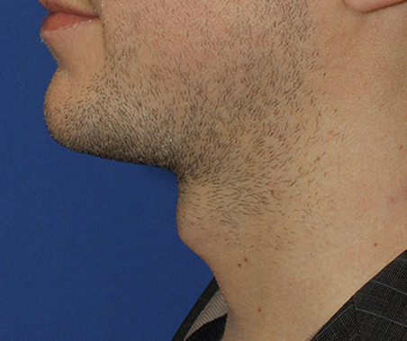 Tracheal Shave Before Profile