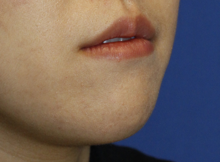 Chin Reduction Before R Oblique