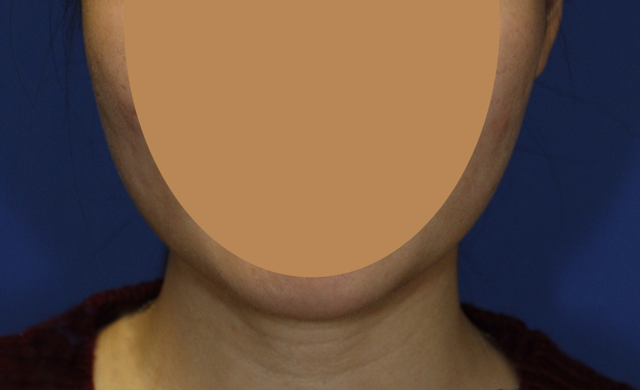 Masseter Muscle Botox After