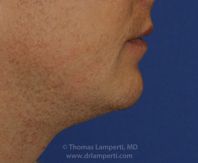Chin Reduction R Profile After