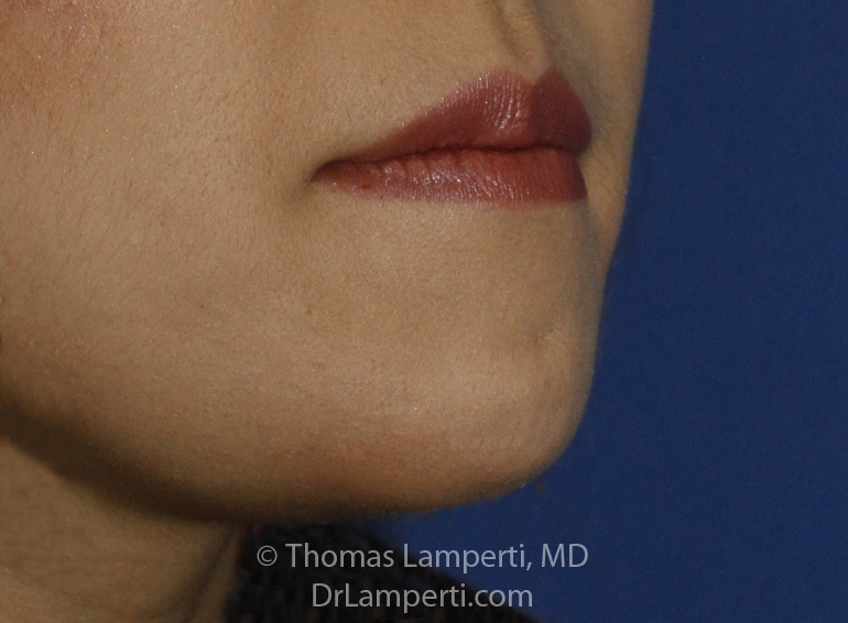 Chin Reduction After R Oblique