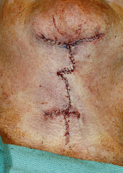 Grecian Urn direct neck lift suture line after photo