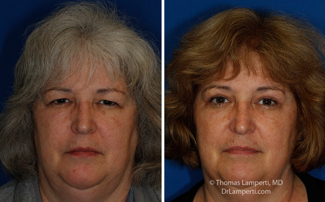 Blepharoplasty patient 51 with endoscopic brow lift frontal montage