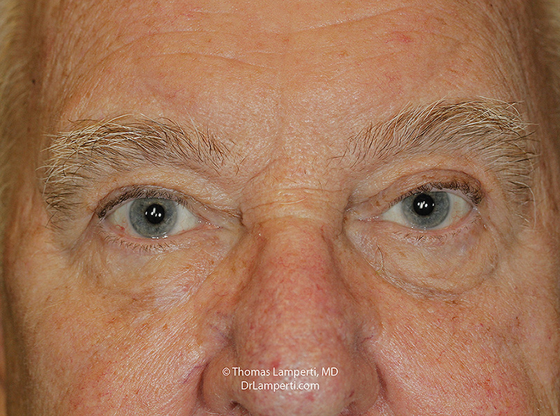 Blepharoplasty brow lift and ptosis repair patient 67 after