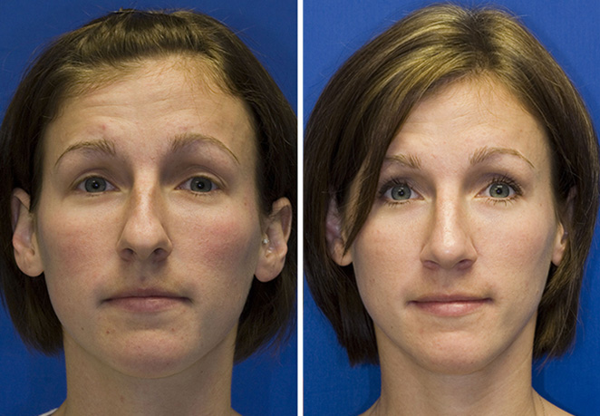 Bulbous tip rhinoplasty before and after