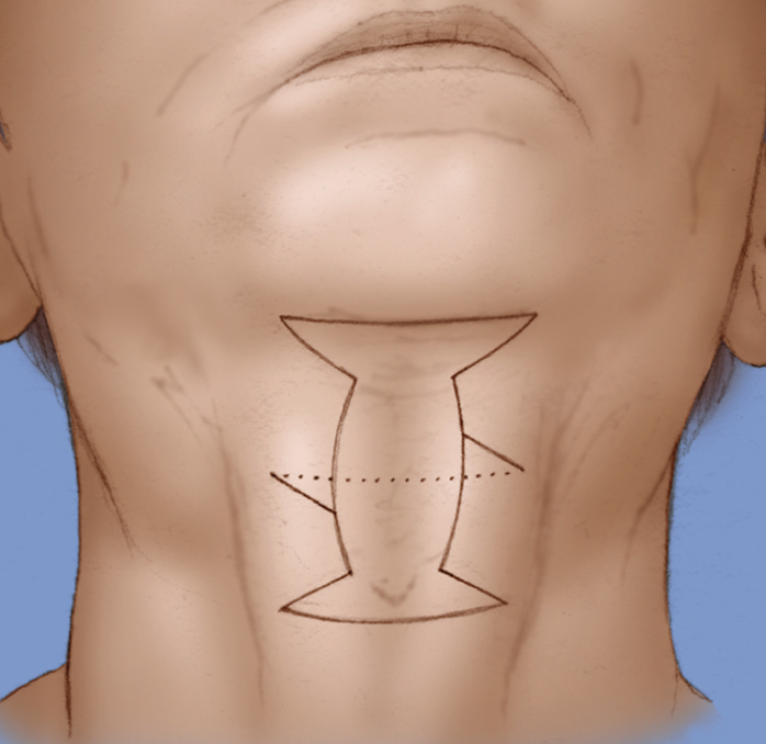 Grecian Urn direct neck lift incision schematic.