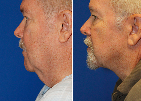 Grecian Urn direct neck lift before and after profile photos. After photo is on the right and wsa taken 1 year after surgery.