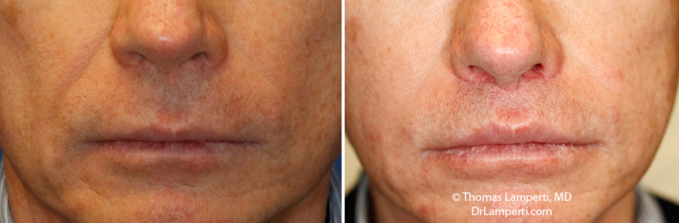 Subnasal lip lift male before and after
