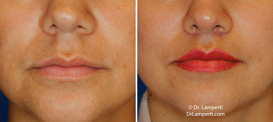 Subnasal lip lift frontal montage before and after