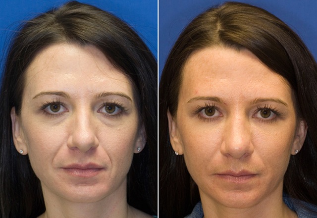 Fat injection for deep facial lines