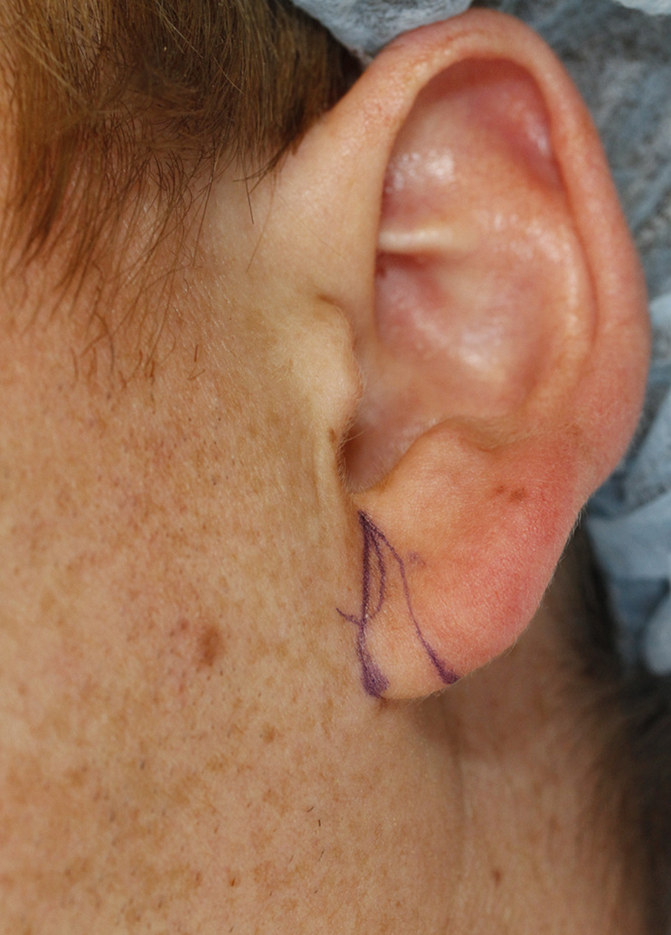 otoplasty-patient-8-l-auricle-detail-with-skin-markings.jpg