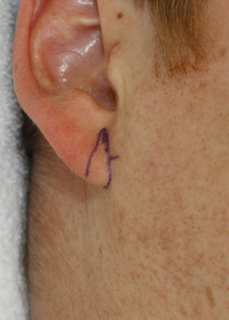 otoplasty-patient-8-r-auricle-detail-with-skin-markings.jpg