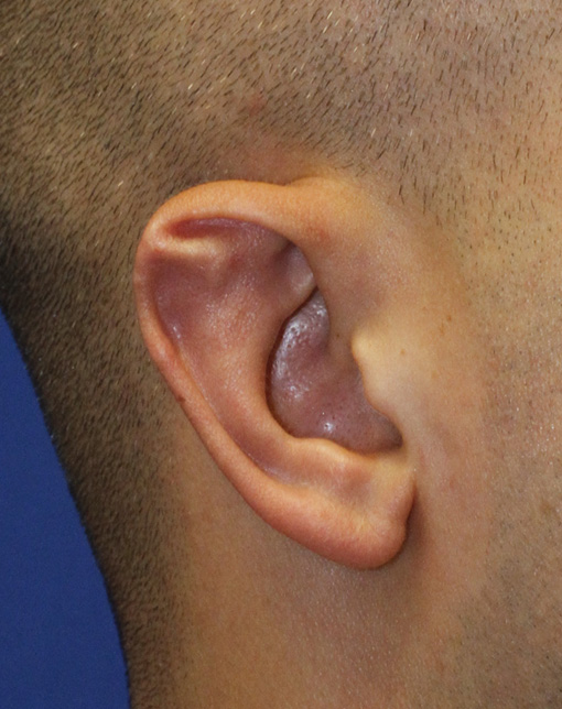 Otoplasty patient 8 right Stahl ear repair before
