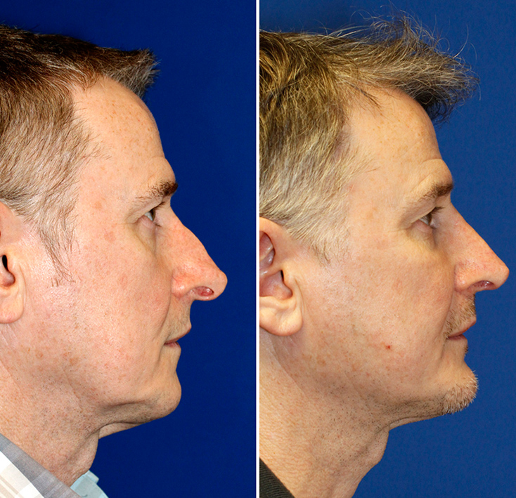 Before and 15 months after revision rhinoplasty to correct a drooping tip with hanging columella and alar retraction