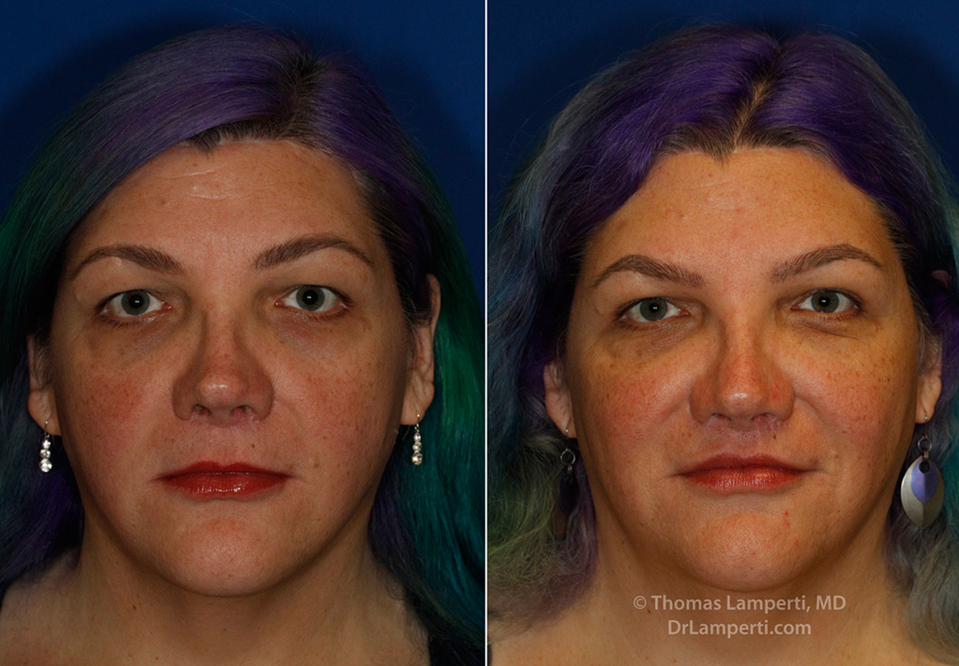 Revision upper lip lift frontal before and after