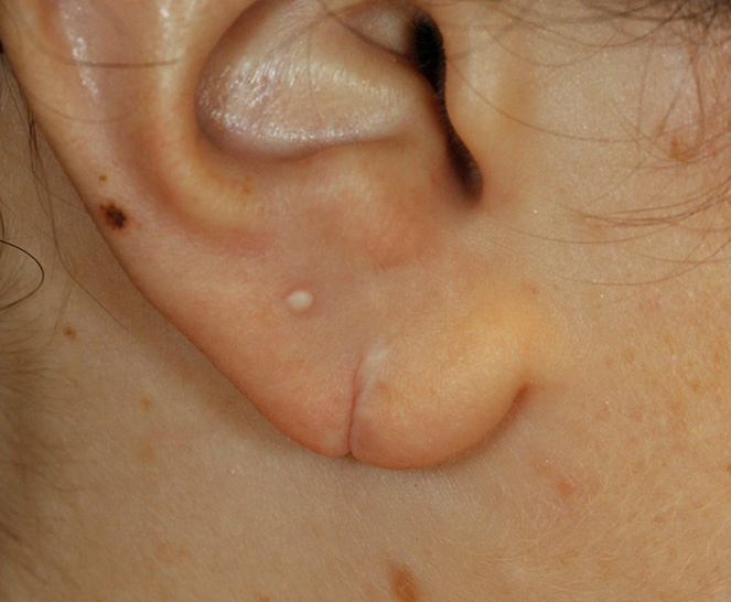 Before torn ear lobe repair crop