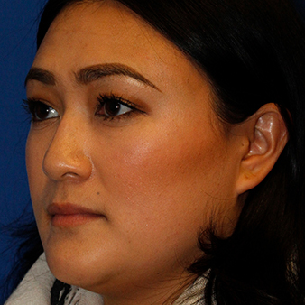 Rhinoplasty before after Seattle top best cosmetic surgeons shapshots »  Rhinoplasty: Cost, Pics, Reviews, Q&A