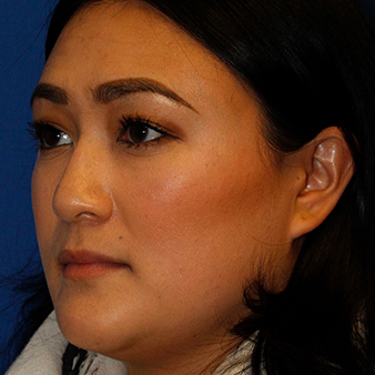 Rhinoplasty Seattle - Bellevue Nose Job