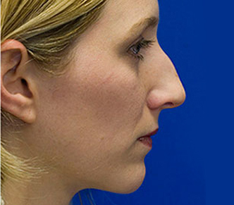 Rhinoplasty Seattle - Rhinoplasty Specialist - Bellevue Rhinoplasty