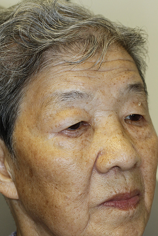 Before Asian Blepharoplasty Oblique