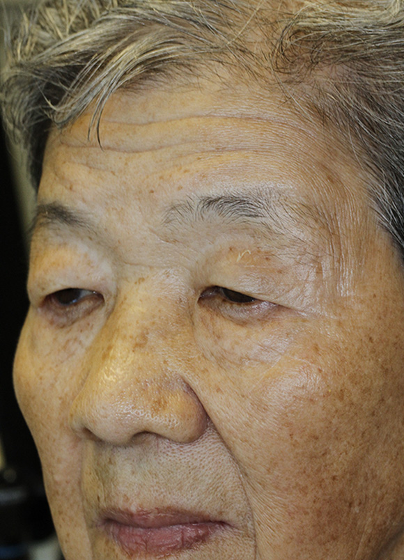 Before Asian Blepharoplasty Oblique